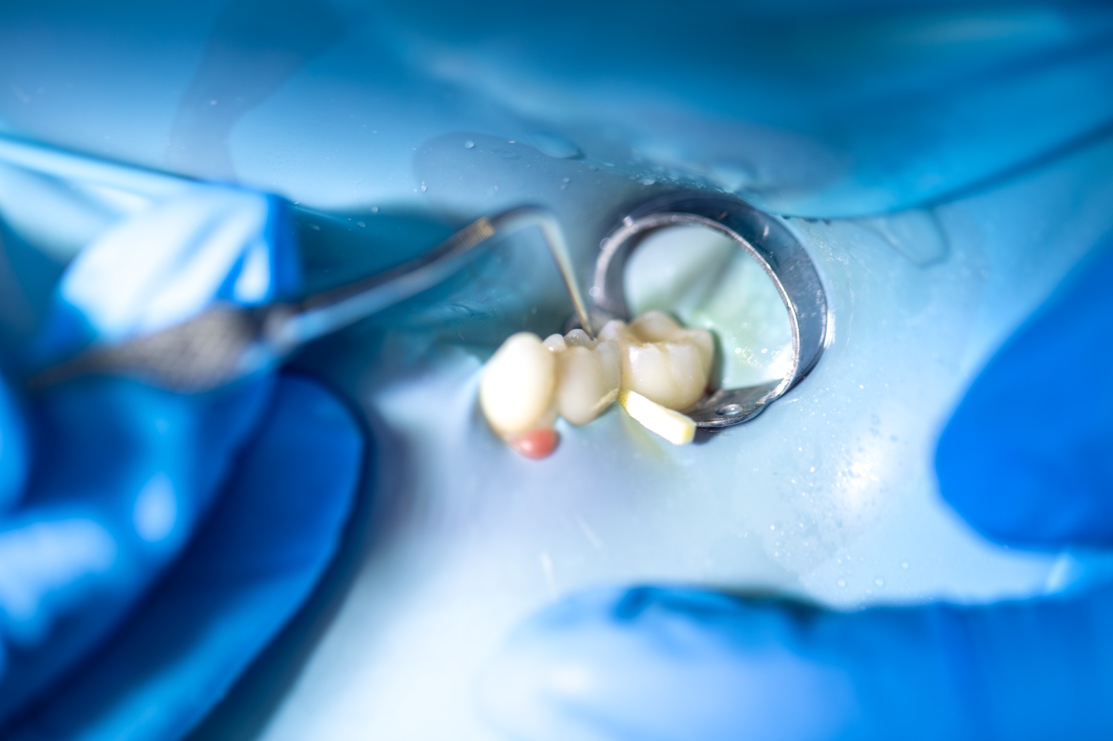 Painless root canal treatment